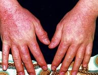 Лечение дерматита народными средствами