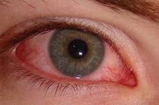 Воспаление глаза лечение
