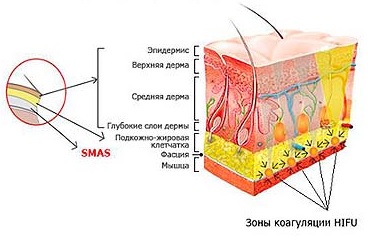 HIFU SMAS: единственный метод воздействия на нижележащий мышечно-апоневротический слой, а не на кожу