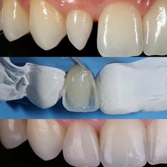 Реставрация зубов :эстетическое восстановление зубного ряда
