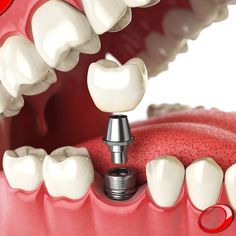 С чего начать протезирование зубов?
