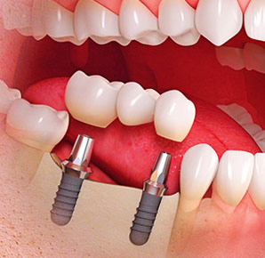 Современные методы протезирования зубов