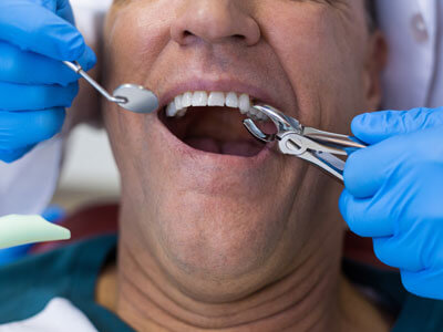 Удаление зуба: крайняя мера в современной стоматологии