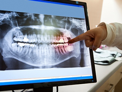 Рентген зубов :помогает стоматологу правильно поставить диагноз и построить план лечения