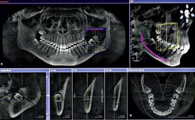 Компьютерная томография челюсти: современный метод неинвазивной диагностики