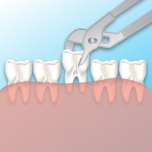 Что нужно знать при удалении зуба?
