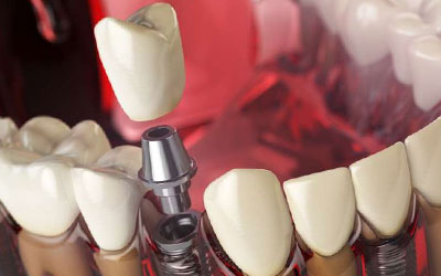 Какие существуют виды зубных имплантов?