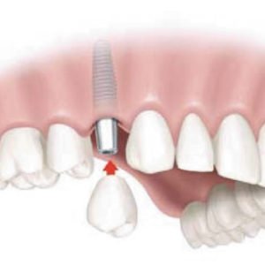 Имплантация: наиболее эффективный и безопасны способ восстановления зубов