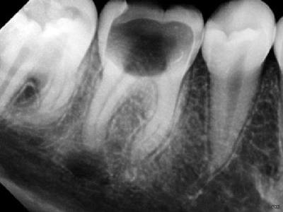 В каких случаях показан рентген зуба ?