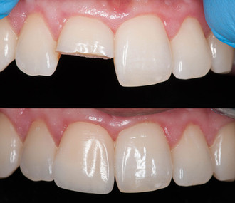 Этапы реставрации передних зубов