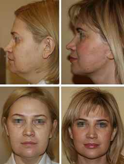 СМАС лифтинг: современная эффективная косметологическая процедура, которая позволяет омолодить кожу и улучшить овал лица