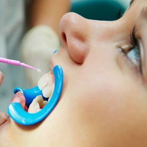 Фторирование зубов у детей: польза и вред