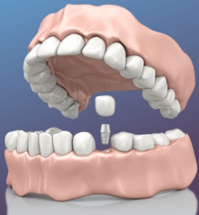 Зубы за 1 день: особенности одноэтапной имплантации с немедленной нагрузкой
