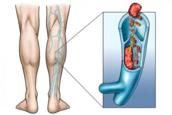 Тромбоз нижних конечностей: причины и лечение