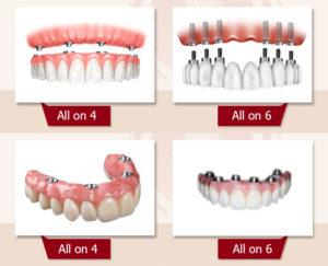 Чем отличается имплантация зубов All-on-4 от All-on-6?