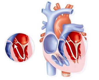 Врожденный порок сердца: методы лечения