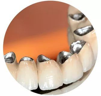 Особенности протезирования зубов металлокерамикой