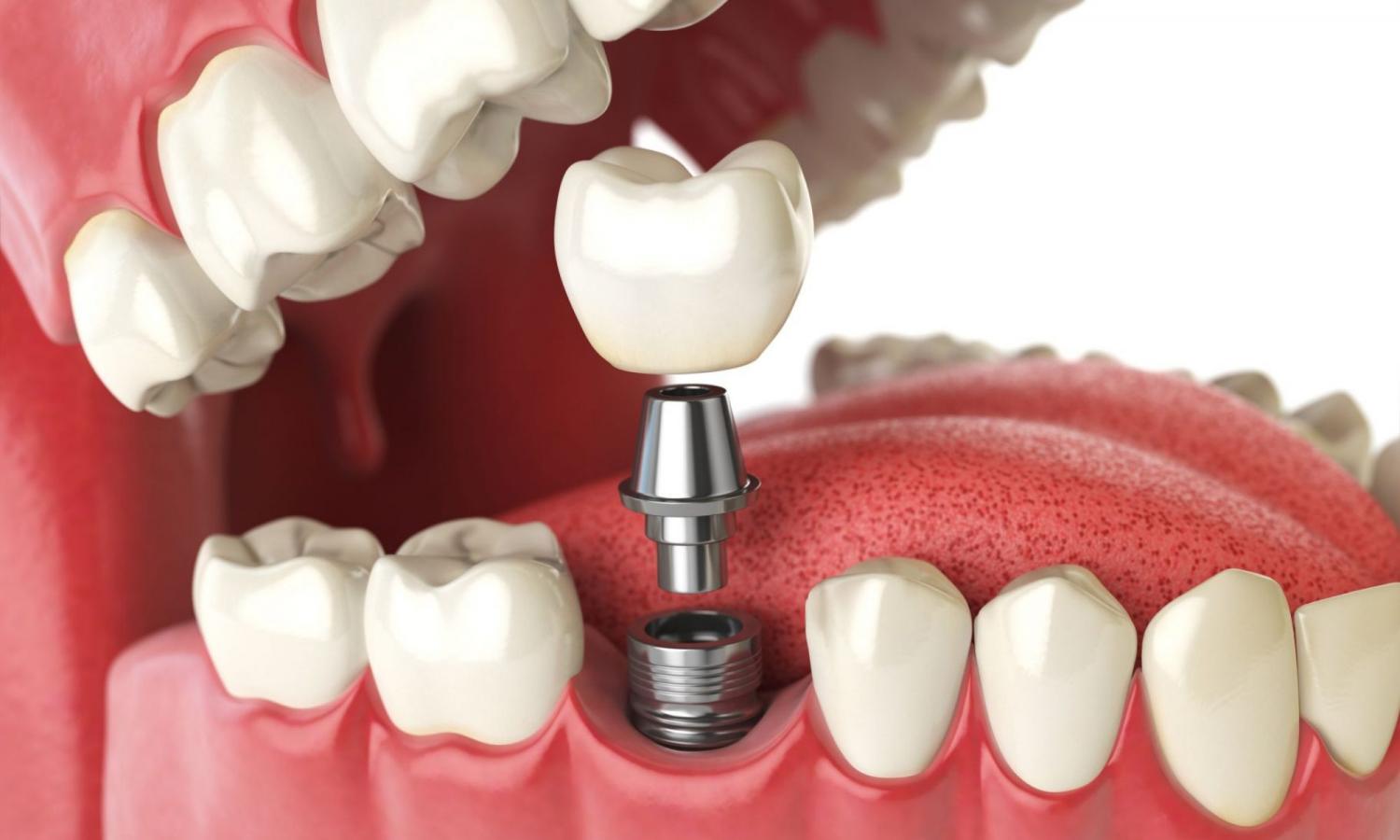 Как подготовиться к имплантации зубов?
