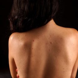 Прыщи на спине: причины возникновения