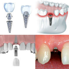 Имплантация зубов: преимущества, особенности, этапы проведения процедуры
