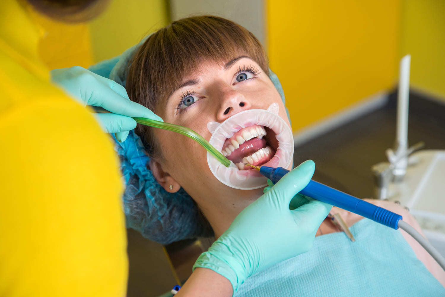 Рекомендации после профессиональной чистки зубов