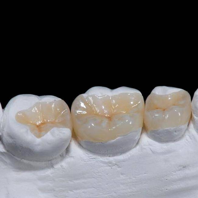 Керамическая вкладка на зуб: промежуточное звено между пломбой и коронкой