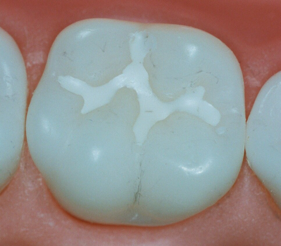 Серебрение зубов: консервативный метод лечения кариеса молочных зубов