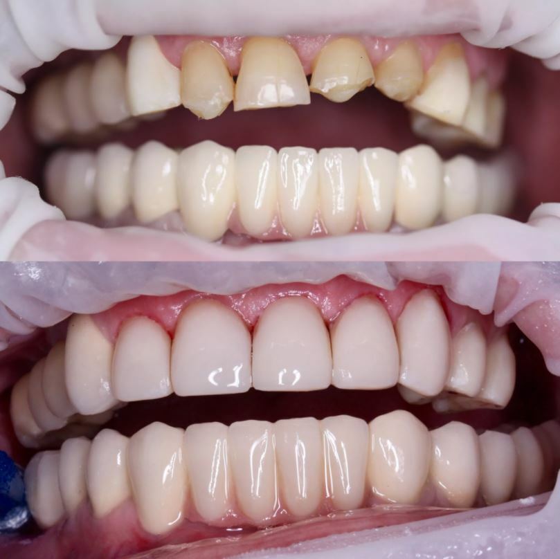 Как и где лучше восстановить зубной ряд и сэкономить на реставрации единицы?