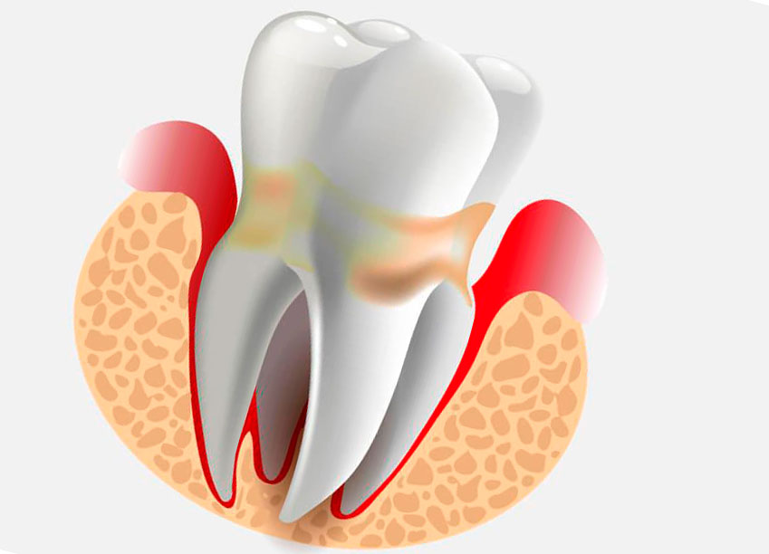 Методы лечения периодонтита зуба