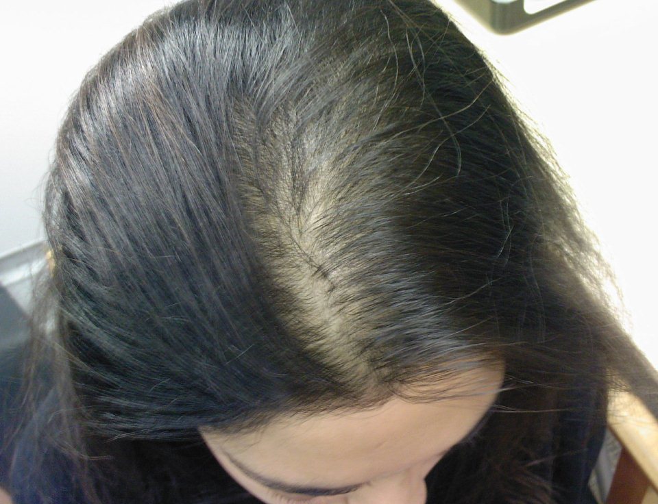 Постковидное выпадение волос