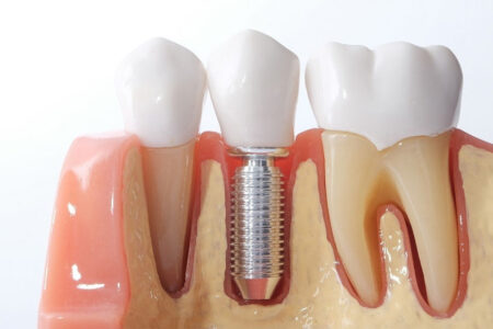 Когда нужно делать имплантацию зубов?