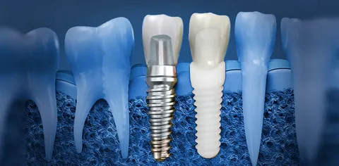 Установка имплантов Dentis