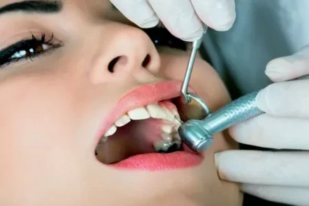 Технологии лечения кариеса зубов