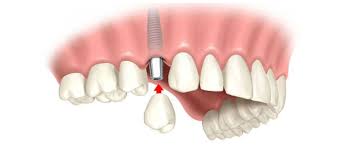 Имплантация: эффективный и безопасный способ восстановления зубов