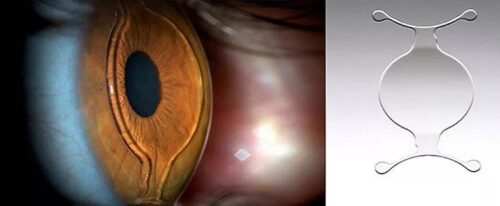 Имплантация факичных линз: позволяет сохранить природный хрусталик глаза и вернуть остроту зрения