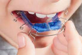 Пластины для выравнивания зубов у детей