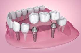 Варианты имплантации зубов