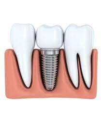 Имплантация зубов: современный метод восстановления утраченных зубов