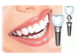 Почему важна имплантация зубов?
