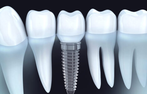 Имплантация зубов в «Dental Effect»