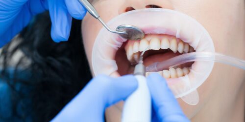 Профессиональная гигиена полости рта стоматологии