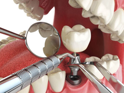 Когда можно делать имплантацию зубов?