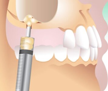 Синус лифтинг в стоматологии