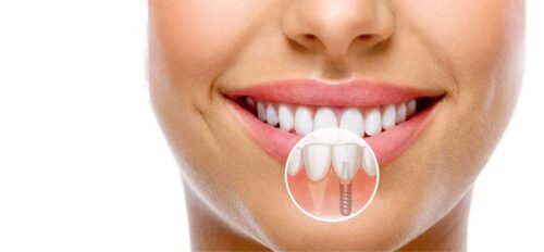 Имплантация зубов в стоматологии Prime Smile