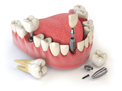 Что входит в протезирование зубов?