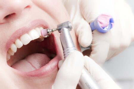 Виды чистки зубов в стоматологии