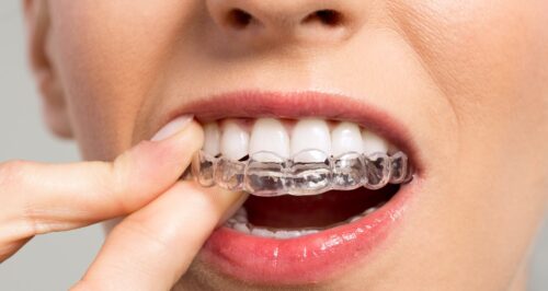 Как работают брекеты для выравнивания зубов?