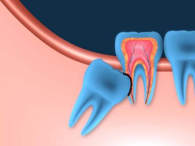 Удаление зуба мудрости: методы и рекомендации