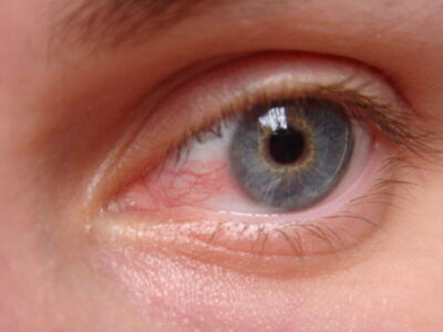 Кератит: опасное воспалительное заболевание глаз
