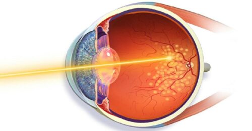 Что представляет собой лазерная коагуляция сетчатки глаза?